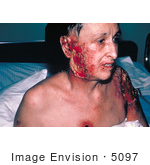 #5097 Picture of a Severe and Progressive Vaccinia Gangrenosum Complications from a Smallpox Vaccination by JVPD