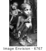 #6767 Picture Of A Kid With Smallpox Disease