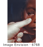 #6768 Picture of a CDC EIS Officer Examining the Palpebral Conjunctiva of a Nigerian Child with Anemia Symptoms by KAPD