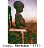 #6769 Picture of a Child with Kwashiorkor Disease from Severe Dietary Protein Deficiency by KAPD