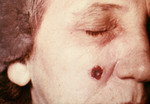 Free Picture of Woman with an Anthrax Skin Lesion on the 13th Day