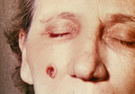 Free Picture of Woman with an Anthrax Skin Lesion on the 5th Day