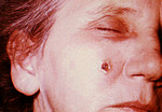 Free Picture of Woman with an Anthrax Skin Lesion on the 8th Day