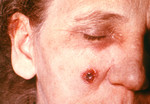 Free Picture of Woman with an Anthrax Skin Lesion on the 11th Day