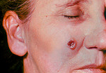 Free Picture of Woman with an Anthrax Skin Lesion on the 6th Day