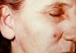 Free Picture of Woman with an Anthrax Skin Lesion on the 4th Day