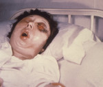 Free Picture of Woman On the 5th Day of an Anthrax Infection Involving Her Eye