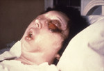 Free Picture of Patient On the 5th Day of an Anthrax Infection In Her Eye