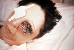 Free Picture of Patient On the 25th Day of an Anthrax Infection Involving Her Eye