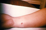 Free Picture of 4th Day of an Anthrax Lesion on a Woman