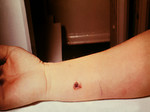 Free Picture of 7th Day of an Anthrax Lesion on a Woman