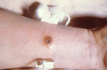 Free Picture of Cutaneous Anthrax Lesion