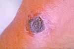 Free Picture of Forearm Anthrax Lesion Which Has Begun to Turn Black