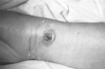Free Picture of Patients Arm with Cutaneous Anthrax Lesion