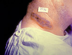 Free Picture of Anthrax Neck Skin Lesion