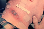 Free Picture of Cutaneous Anthrax Lesion on the Neck of a Man