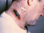 Free Picture of Man with a Cutaneous Anthrax Lesion On His Neck