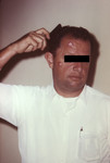 Free Picture of Man with Cutaneous Anthrax Due to Bacillus Anthracis