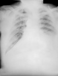 Free Picture of Chest Radiograph During the 4th Day of Anthrax Illness