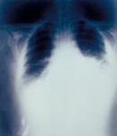 Free Picture of Radiograph of Anthrax Inhalation 22 Hours Before Death