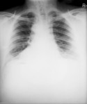 Free Picture of Chest X-ray of a 46 Year Old Man Diagnosed with the Anthrax Disease