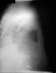Free Picture of Lateral Chest Radiograph of Anthrax On the 13th Day