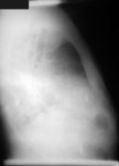 Free Picture of Lateral Chest Radiograph of Anthrax On the 4th Day of Illness