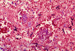 Free Picture of Histopathology of Mediastinal Lymph Node in Fatal Human Anthrax