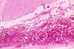 Free Picture of Hemorrhagic Meningitis due to the Fatal Inhalation Anthrax