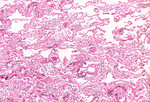 Free Picture of Micrograph of the Fatal Inhalation of Anthrax in a Person