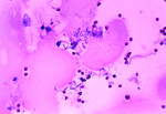 Free Picture of Human Meningitis with the Presence of Bacillus Anthracis
