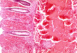 Free Picture of Histopathology Of Large Intestine In Fatal Human Anthrax
