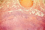 Free Picture of Necrosis Of Lymph Node Due To Anthrax
