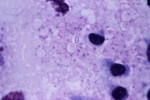 Free Picture of Mediastinal Lymph Node from a Cynomolgus Monkey Infected with Anthrax.