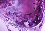 Free Picture of Hemorrhagic Necrosis of a Lymph Node due to the Anthrax Disease