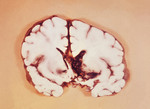 Free Picture of Brain Slice Revealing an Interventricular Hemorrhage