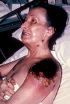 Free Picture of Female Patient with Vaccinia Gangrenosum