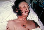 Free Picture of Woman with Progressive Vaccinia Gangrenosum