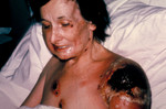 Free Picture of Patient Progressive Vaccinia After Being Vaccinated for Smallpox
