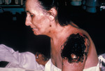 Free Picture of Ill Patient with Life Threatening Progressive Vaccinia Gangrenosum