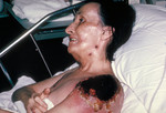 Free Picture of Progressive Vaccinia Gangrenosum On the Shoulder of a Woman