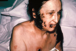 Free Picture of Life Threatening Progressive Vaccinia On a Woman