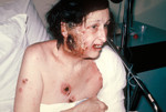 Free Picture of Hospitalized Woman Showing Severe Complications of a Smallpox Vaccination