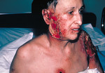 Free Picture of Severe and Progressive Vaccinia Gangrenosum Complications from a Smallpox Vaccination
