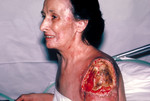 Free Picture of Progressive Vaccinia Gangrenosum On a Patient