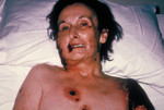 Free Picture of Female Patient with Progressive Vaccinia from a Smallpox Vaccination