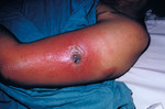 Free Picture of Female Patient Presented with Vaccinia Gangrenosum 1 Month After a Smallpox Vaccination