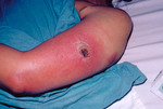 Free Picture of Patient with Vaccinia Gangrenosum 1 Month after a Smallpox Vaccination
