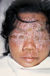 Free Picture of 28 Year Old Woman with Eczema Vaccinatum