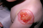 Free Picture of Patient with Progressive Vaccinia On His Shoulder